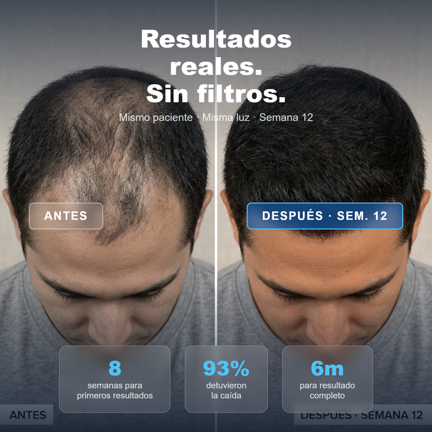 ELLOS™ Cabello Para el DHT. Finasteride + Minoxidil + Biotina. Recupera tu cabello hoy.